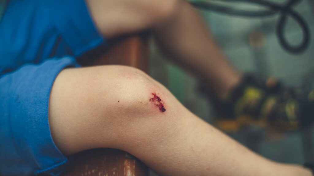 Schaafwond op de knie van een kind, een klassiek voorbeeld waarbij goede wondverzorging essentieel is