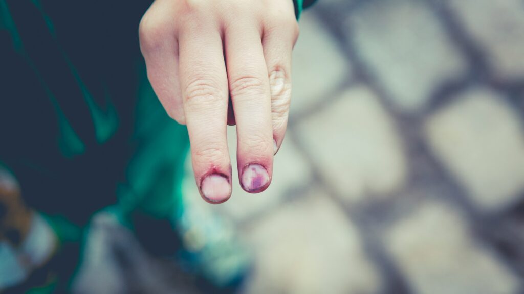 Blauwe nagels en wondjes op vingers van een kind, tekenen van trauma die wondverzorging vereisen